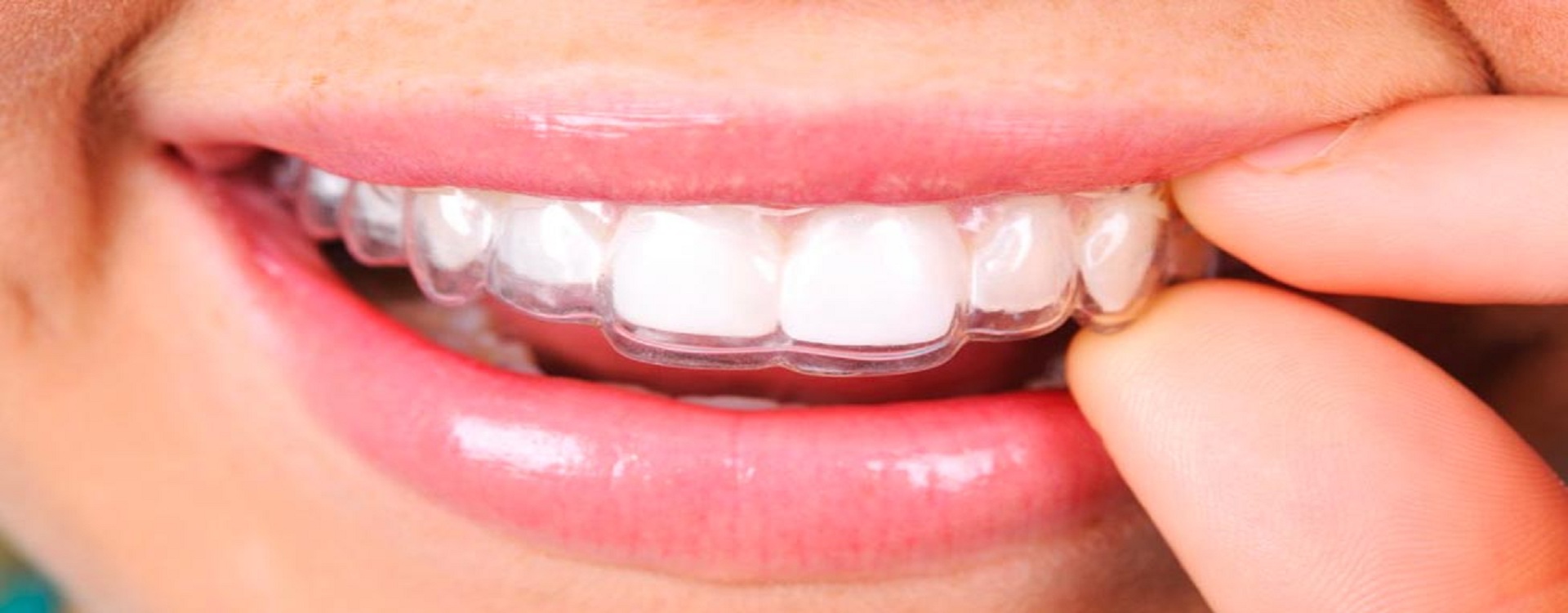 dental treatment in vibhuti khand lucknow