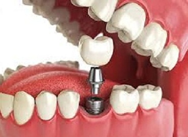 Dental Clinic in Gomti Nagar,Dental Clinic in vibhuti khand,Dental clinic in vishesh khand,dental clinic near shaheed path,Dentist in Gomti Nagar,Dentist in vibhuti khand,Dentist in vishesh khand,Dentist near shaheed path,Dental clinic in lucknow,dentist in lucknow,top dental clinic in gomti nagar,top dental clinic in vibhuti khand,top dental clinic in vishesh khand,top dental clinic  near shaheed path,top dentist in gomti nagar,top dentist in vibhuti khand,top dentist in vishesh khand