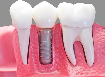 Dental Clinic in Gomti Nagar,Dental Clinic in vibhuti khand,Dental clinic in vishesh khand,dental clinic near shaheed path,Dentist in Gomti Nagar,Dentist in vibhuti khand,Dentist in vishesh khand,Dentist near shaheed path,Dental clinic in lucknow,dentist in lucknow,top dental clinic in gomti nagar,top dental clinic in vibhuti khand,top dental clinic in vishesh khand,top dental clinic  near shaheed path,top dentist in gomti nagar,top dentist in vibhuti khand,top dentist in vishesh khand